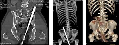 Rare penetrating abdominal injury caused by falling from height: Miraculously good prognosis